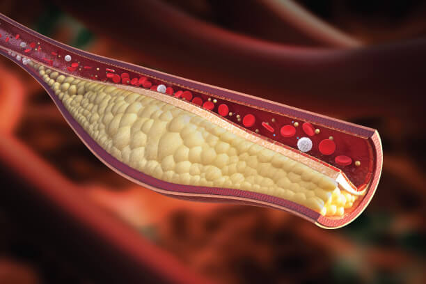 Cholesterol level Cholesterol level