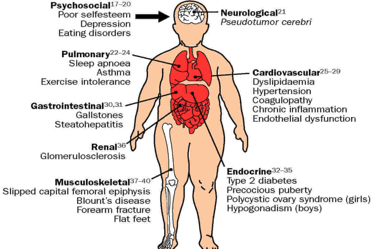 Effects of childhood obesity. child obesity effects