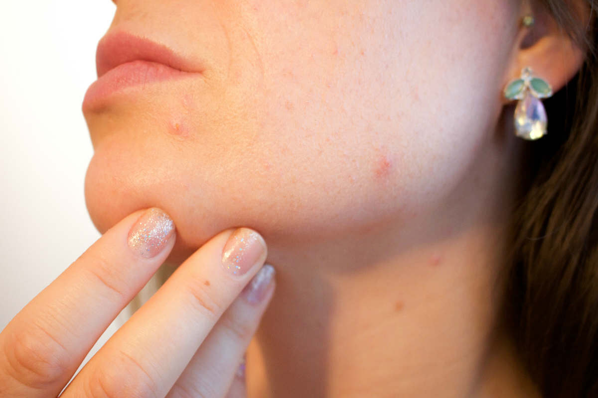 PCOS acne PCOS acne